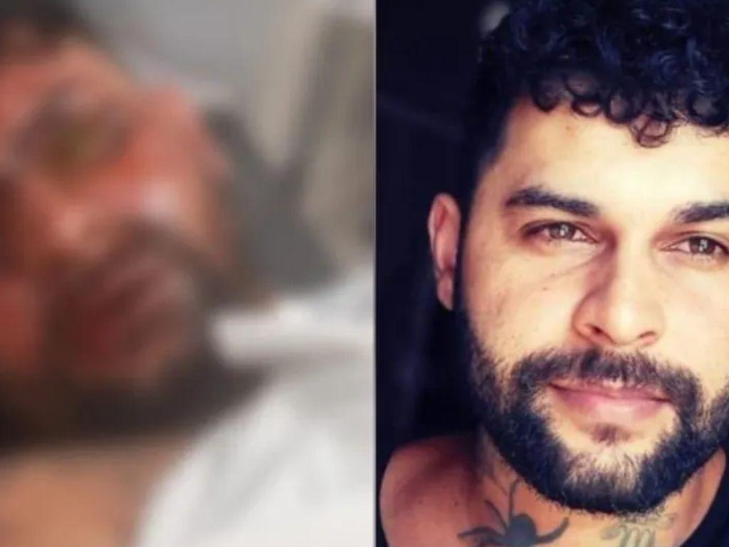 Tatuador cego por ataque com soda cáustica enfrenta perda do olho em transplante